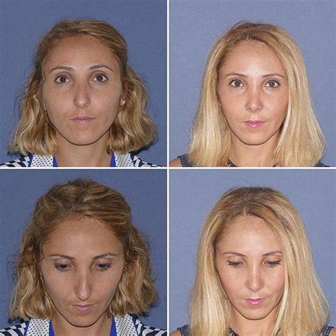 Deviated Septum Pictures Of Before And After (3) » Rhinoplasty: Cost ...