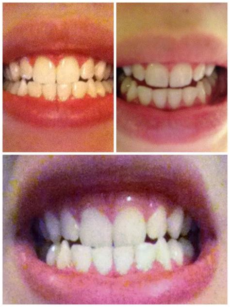 DIY Teeth Whitening: Smile Brilliant Review [Updated 2024] - Inspired Bride