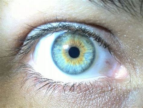 Central heterochromia Iridis | Heterochromia Iridum | Pinterest