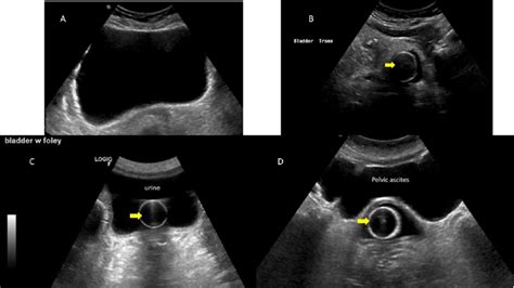 Bladder ultrasound. A) Normal transverse ultrasound of a full bladder.... | Download Scientific ...