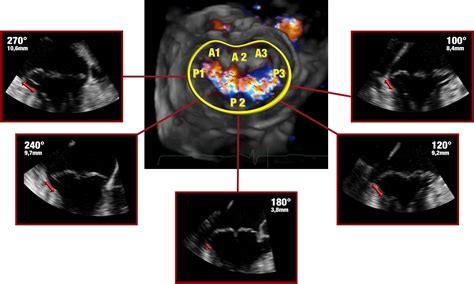 Echocardiogram Mitral Valve Prolapse