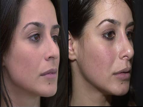 Nose surgery - Sadove Cosmetic Surgery