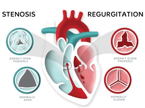 Heart Valve Disease – What does that mean?