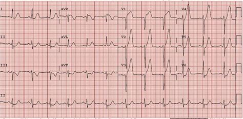 Dr. Smith's ECG Blog: HyperKalemia with Cardiac Arrest. Peaked T waves: Hyperacute (STEMI) vs ...