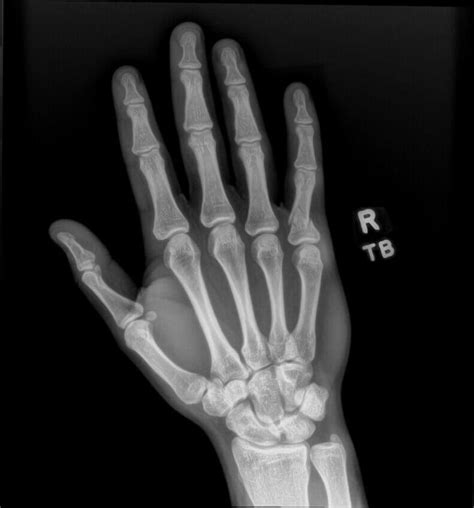 OrthoDx: Proximal Phalanx Fracture - Clinical Advisor