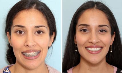 Effects of Jaw Surgery Before and After | New Health Advisor