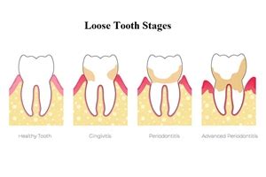 Stages of a loose tooth | News | Dentagama