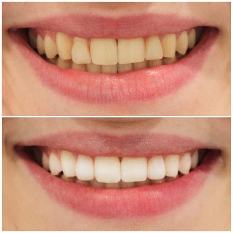 Dental Work Before & After Pictures | Smiling Dental