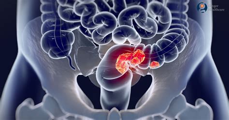 Colorectal Cancer: Symptoms, Causes, Diagnosis & Treatment options