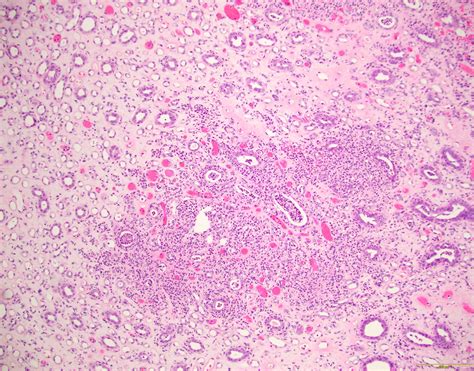 Chronic Pyelonephritis Histology