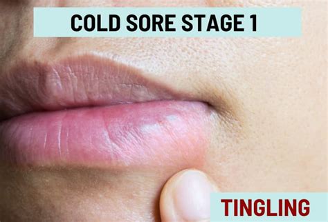 Cold Sore Stages, with Pictures