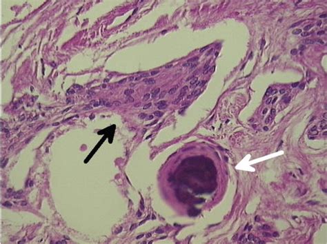 Arachnoid Granulations Histology