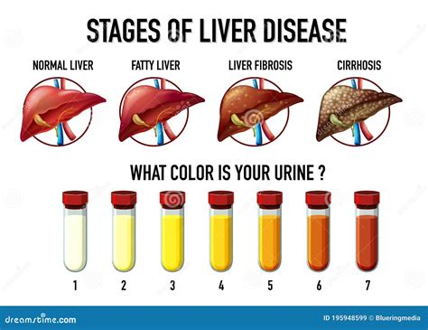 Stages Of Liver Damage. The First Symptoms Of Liver Problems Are Abdominal Pain, Swollen Belly ...