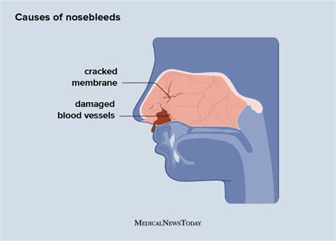 Causes Of Blood In Mucus