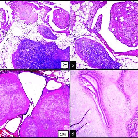 (PDF) Pulmonary hamartoma, a rare benign tumour of the lung - Case series