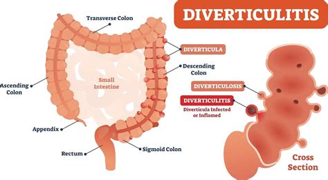 Understanding Diverticulitis: Symptoms & Treatment | Performance Health