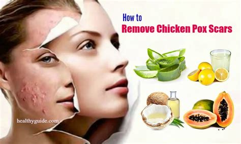 20 Tips How to Remove Chicken Pox Scars on Face Skin Naturally after a Week