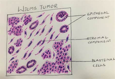 WILMS TUMOR – Histopathology.guru