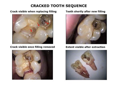 Cracked Tooth Diagram