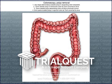 Colonoscopy, Polyp Removal - TrialQuest Inc.