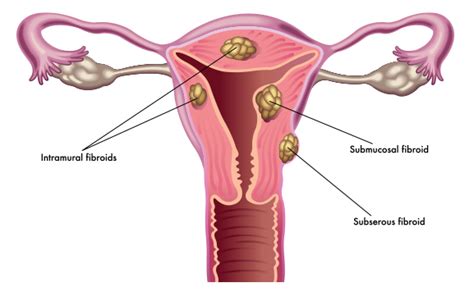 Fibroid Tumors Information & Types | Fibroid Treatment Collective