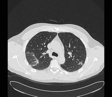 Radiopaedia Organizing Pneumonia Histologically both cryptogenic organizing pneumonia and ...