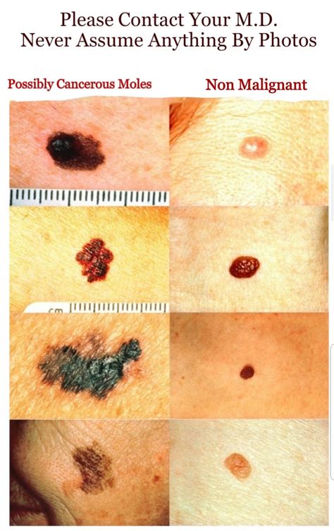 How to Check Your Moles for Skin Cancer (Melanoma)- See Pictures of ...