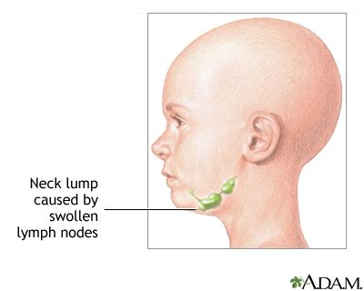 Gallery For > Lump Under Chin In The Middle