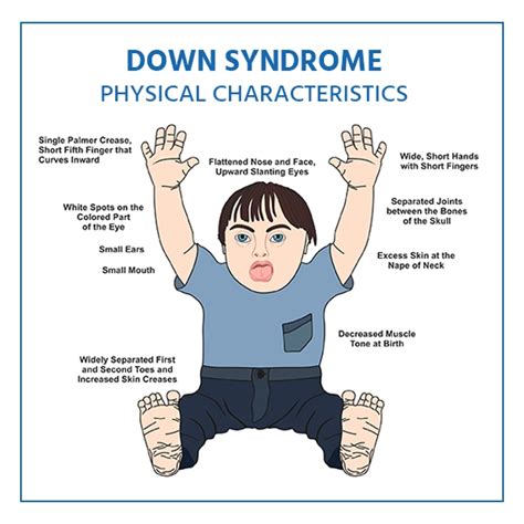 Down Syndrome: Types, Symptoms, Causes & Treatment