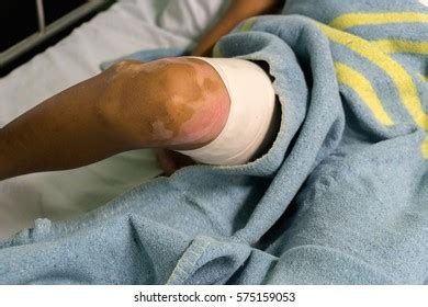 Nursing Care Patient Burn Unit Hospital Stock Photo 575159053 | Shutterstock