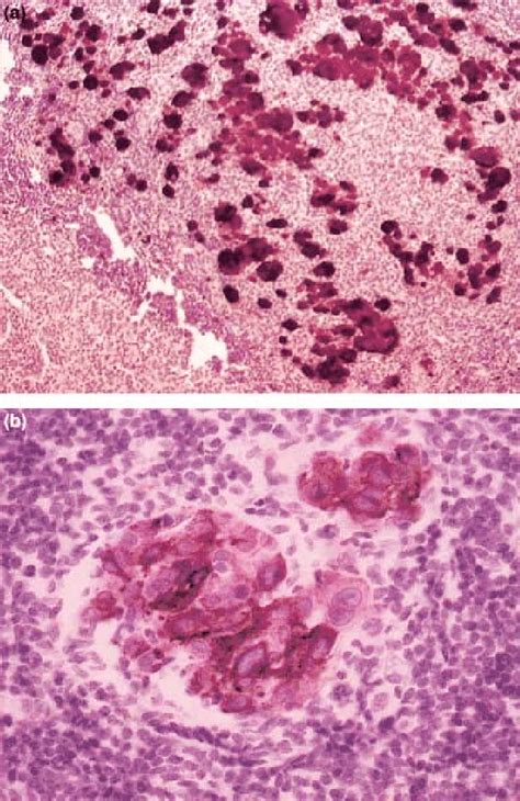 Histological examination of the sentinel lymph node. The sentinel lymph... | Download Scientific ...