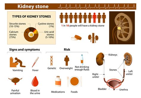 What Causes Struvite & Staghorn Kidney Stones? | Blog | www.lencolab.com