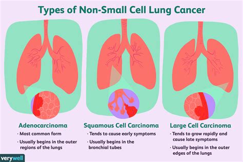 Non-Small Cell Lung Cancer: Overview and More