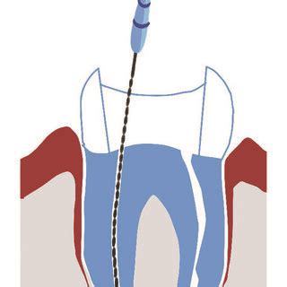 Healing of periapical lesion is achieved in 60 days with mild to... | Download Scientific Diagram