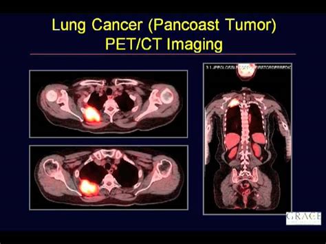 Pet Scan Cancer