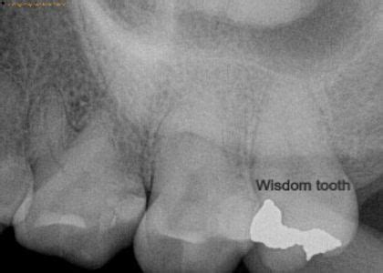 Wisdom Teeth Xray - Gallery - 1311 Jackson Ave Dental | Dentist in Long ...