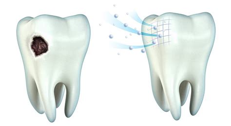 Remineralizing therapy - S.I.Y. Dental