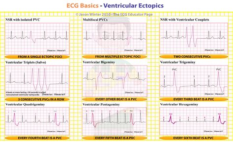 ECG Educator Blog : Ventricular Ectopics