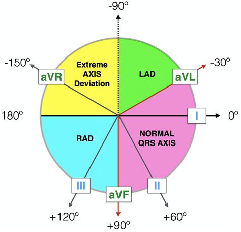 Right Axis Deviation (RAD) • LITFL • ECG Library Diagnosis