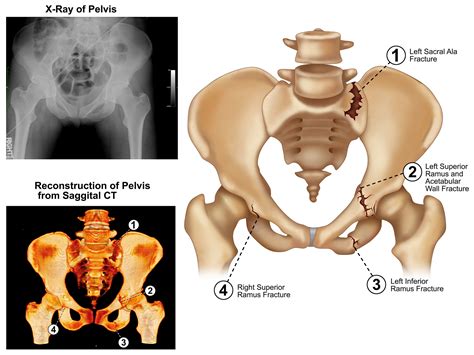 Pelvic Fractures – Medmovie.com