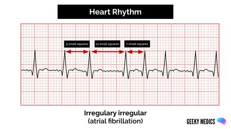 How to read an ECG | ECG Interpretation | Geeky Medics