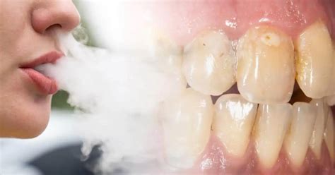 Five Ways Vaping Ruins Your Teeth – And One Is Irreversible - Vape Monitor