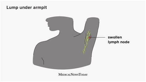 Swollen lymph nodes in armpit: Symptoms, causes, and treatment