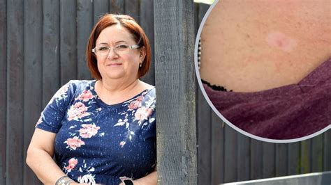 Nurse from Barry shocked after 'small red lump' on chest became stage 2 skin cancer | ITV News Wales