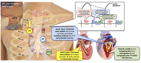 Aortic Insufficiency (Regurgitation) - CodeHealth