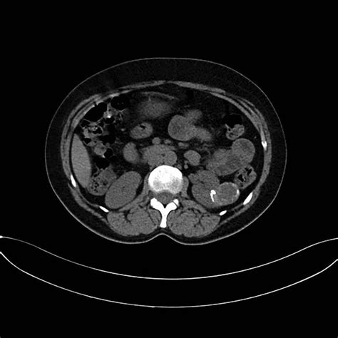 Noncontrast CT scan: water density renal mass, compatible with a simple... | Download Scientific ...