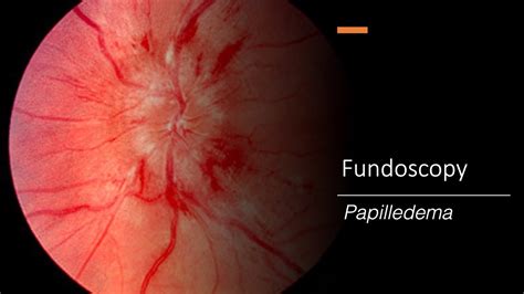 Papilledema: Fundoscopy - YouTube