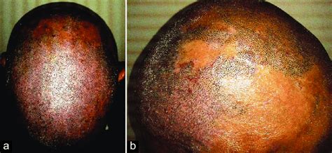 Figure1: (a) Psoriasis lesions with normal hair growth and involving ...