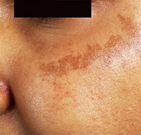 brown spots appearing on skin - pictures, photos