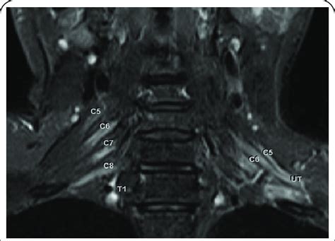 Brachial Plexus Mri Anatomy / Presentation2 Radiological Imaging Of Brachial Plexus Pathology ...